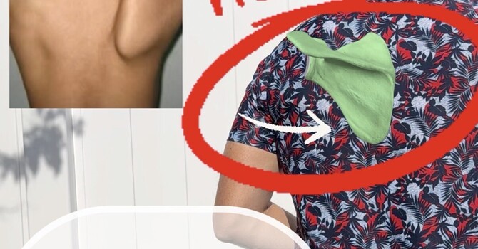 Fixing Winged Scapula: A Common Cause of Shoulder Pain